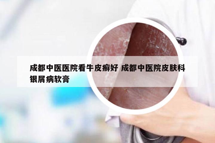 成都中医医院看牛皮癣好 成都中医院皮肤科银屑病软膏
