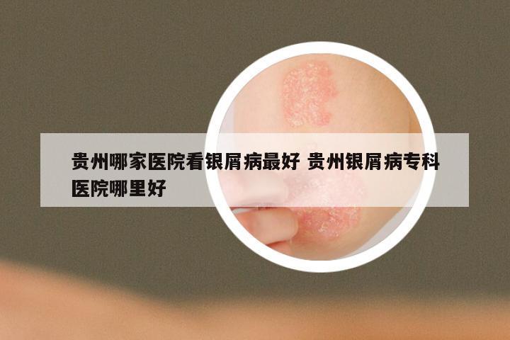 贵州哪家医院看银屑病最好 贵州银屑病专科医院哪里好