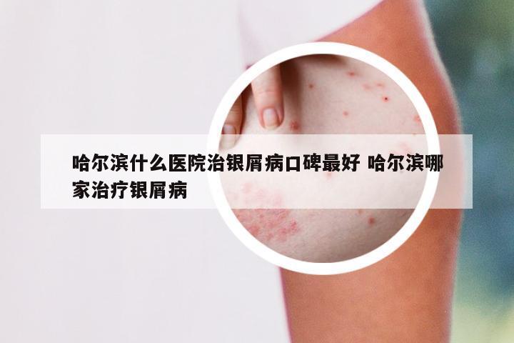 哈尔滨什么医院治银屑病口碑最好 哈尔滨哪家治疗银屑病