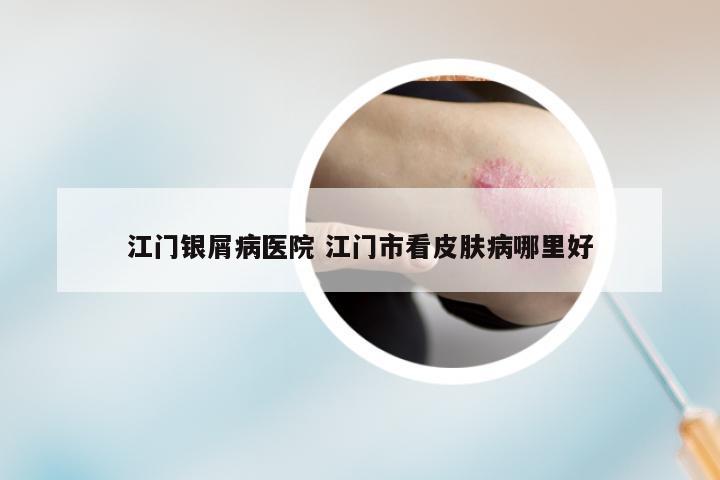 江门银屑病医院 江门市看皮肤病哪里好