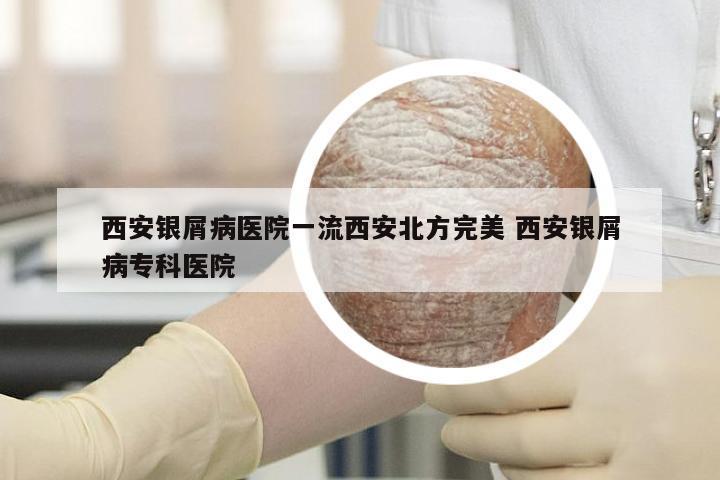 西安银屑病医院一流西安北方完美 西安银屑病专科医院