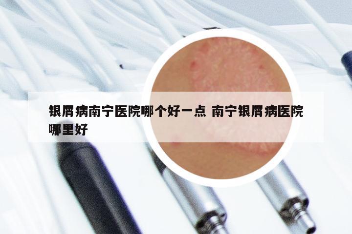 银屑病南宁医院哪个好一点 南宁银屑病医院哪里好