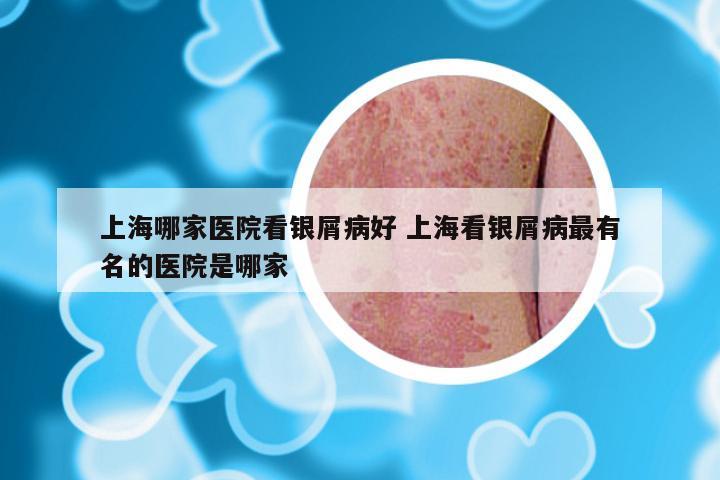 上海哪家医院看银屑病好 上海看银屑病最有名的医院是哪家