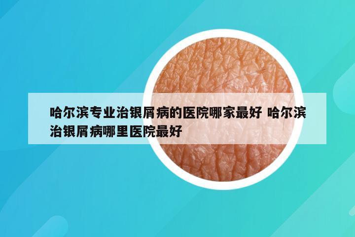 哈尔滨专业治银屑病的医院哪家最好 哈尔滨治银屑病哪里医院最好