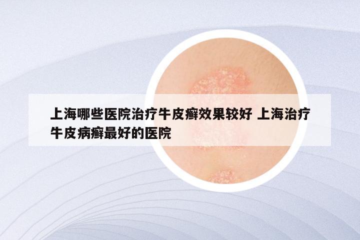 上海哪些医院治疗牛皮癣效果较好 上海治疗牛皮病癣最好的医院