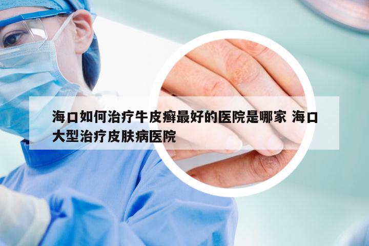 海口如何治疗牛皮癣最好的医院是哪家 海口大型治疗皮肤病医院