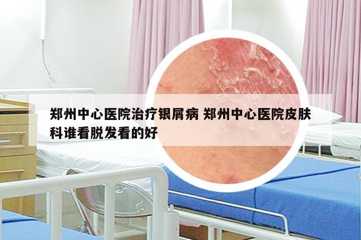 郑州中心医院治疗银屑病 郑州中心医院皮肤科谁看脱发看的好