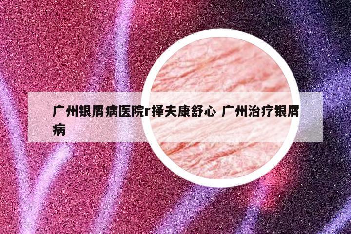广州银屑病医院r择夫康舒心 广州治疗银屑病