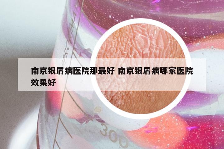 南京银屑病医院那最好 南京银屑病哪家医院效果好