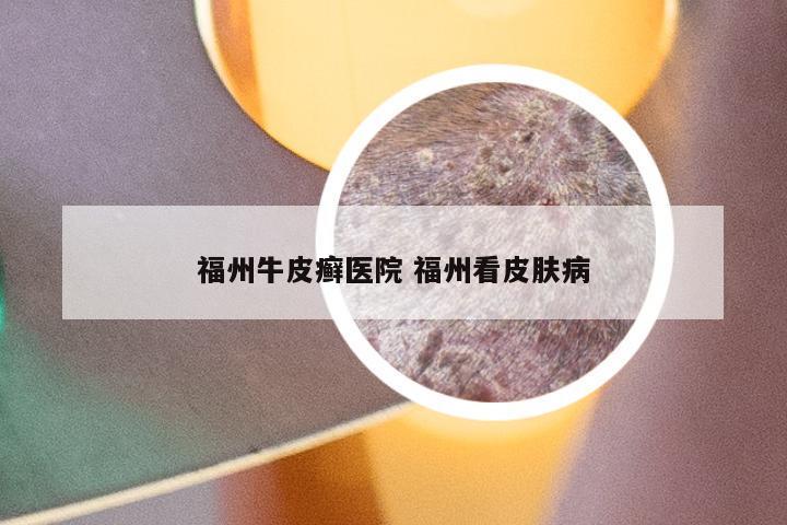 福州牛皮癣医院 福州看皮肤病