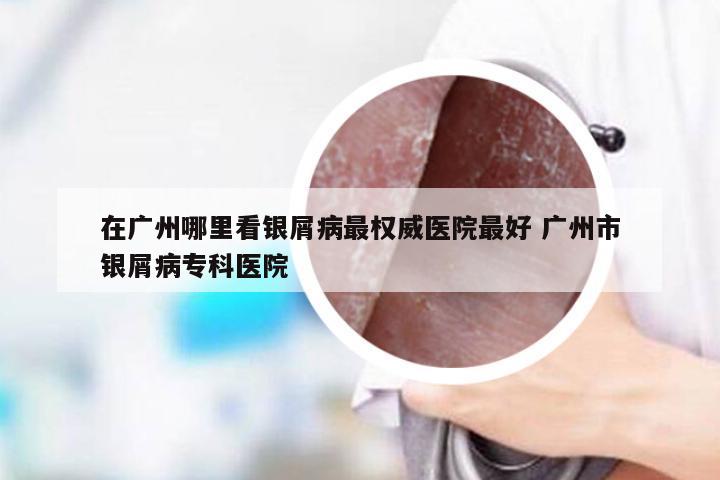 在广州哪里看银屑病最权威医院最好 广州市银屑病专科医院
