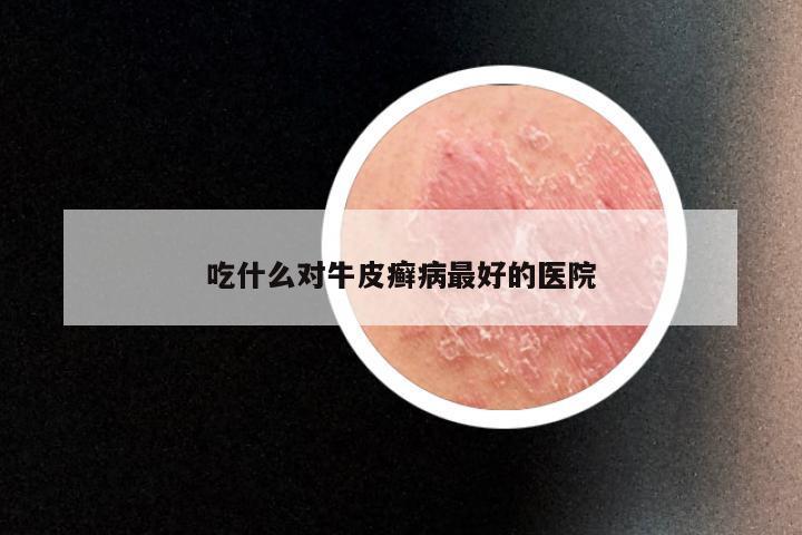 吃什么对牛皮癣病最好的医院