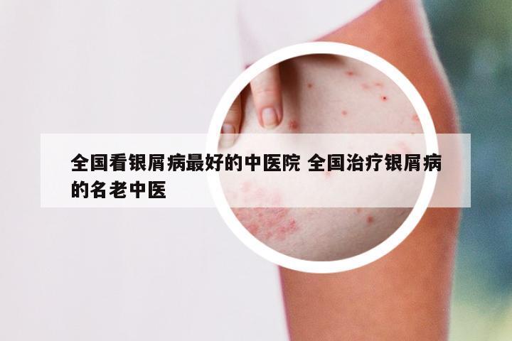 全国看银屑病最好的中医院 全国治疗银屑病的名老中医