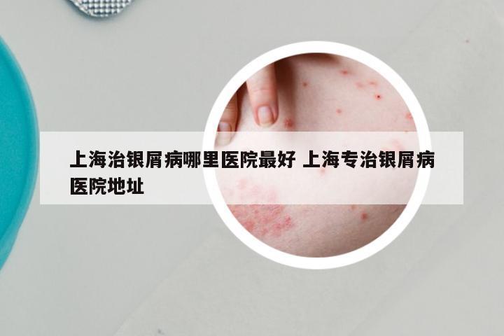 上海治银屑病哪里医院最好 上海专治银屑病医院地址