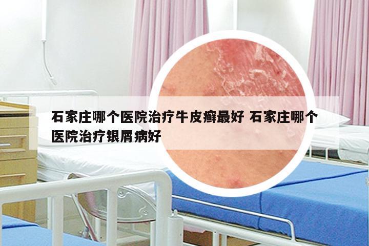 石家庄哪个医院治疗牛皮癣最好 石家庄哪个医院治疗银屑病好