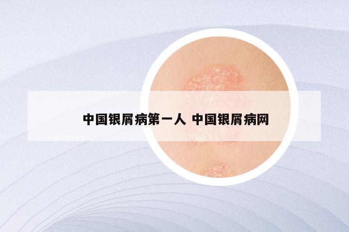 中国银屑病第一人 中国银屑病网