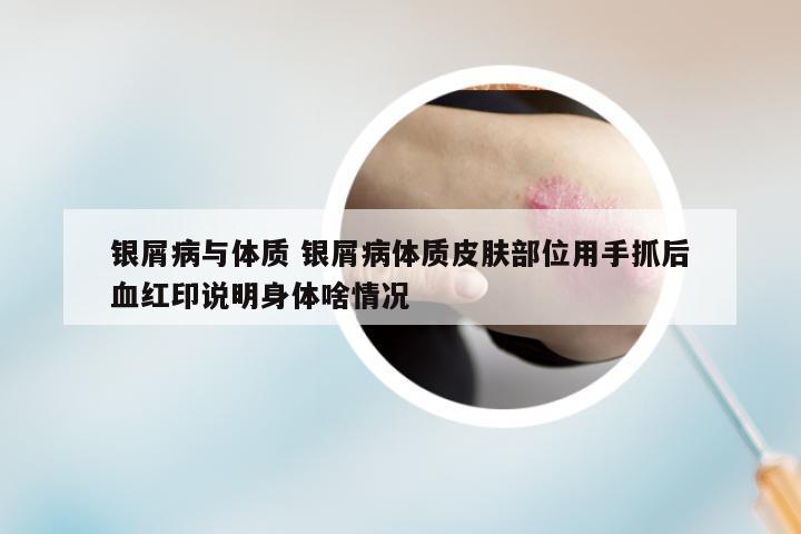 银屑病与体质 银屑病体质皮肤部位用手抓后血红印说明身体啥情况