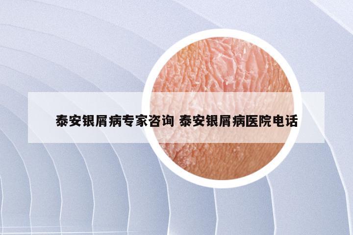 泰安银屑病专家咨询 泰安银屑病医院电话