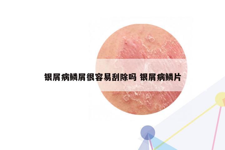 银屑病鳞屑很容易刮除吗 银屑病鳞片