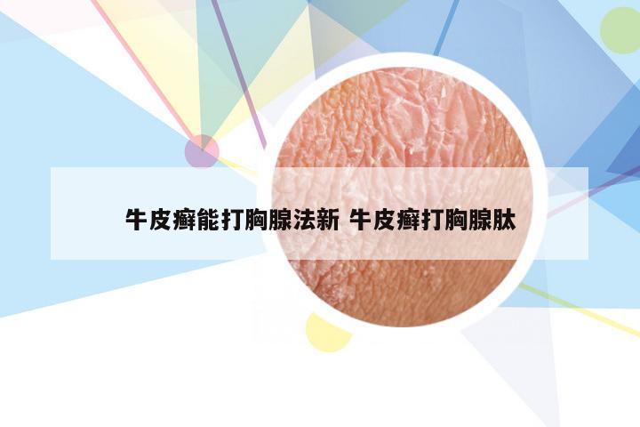 牛皮癣能打胸腺法新 牛皮癣打胸腺肽
