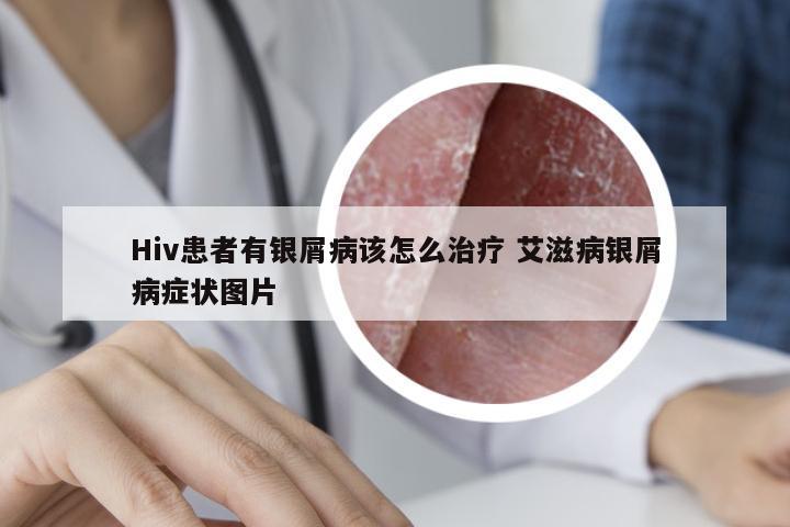 Hiv患者有银屑病该怎么治疗 艾滋病银屑病症状图片