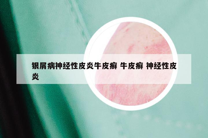 银屑病神经性皮炎牛皮癣 牛皮癣 神经性皮炎