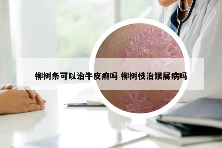 柳树条可以治牛皮癣吗 柳树枝治银屑病吗