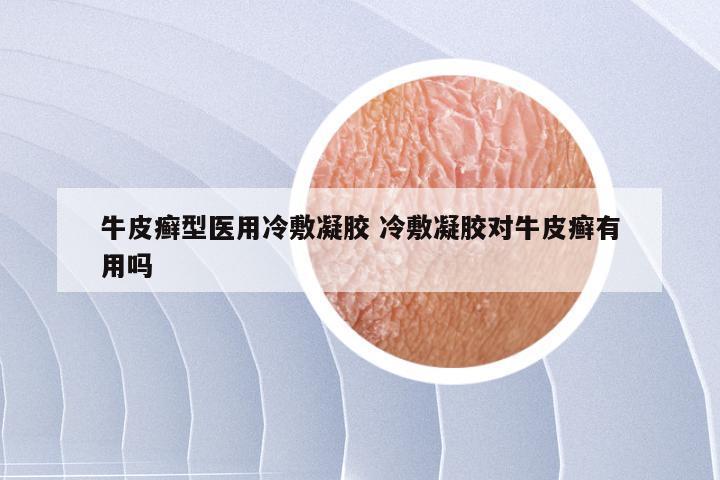 牛皮癣型医用冷敷凝胶 冷敷凝胶对牛皮癣有用吗