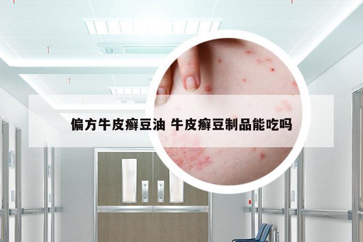偏方牛皮癣豆油 牛皮癣豆制品能吃吗