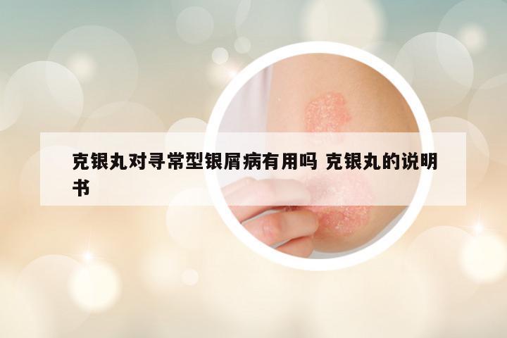 克银丸对寻常型银屑病有用吗 克银丸的说明书
