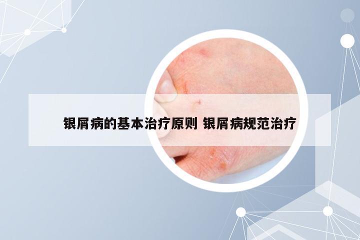 银屑病的基本治疗原则 银屑病规范治疗