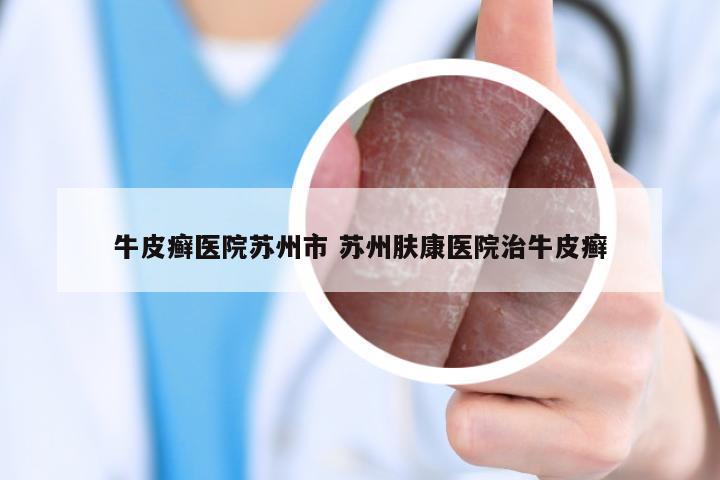 牛皮癣医院苏州市 苏州肤康医院治牛皮癣