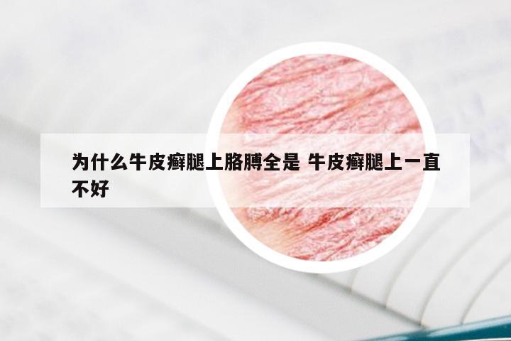 为什么牛皮癣腿上胳膊全是 牛皮癣腿上一直不好