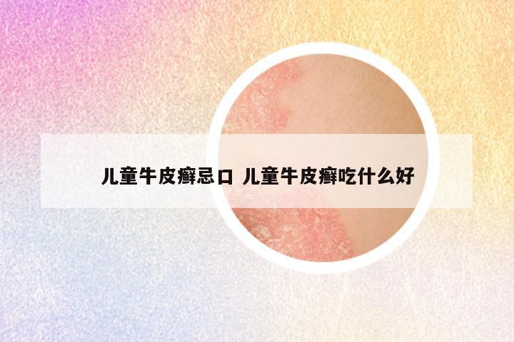 儿童牛皮癣忌口 儿童牛皮癣吃什么好