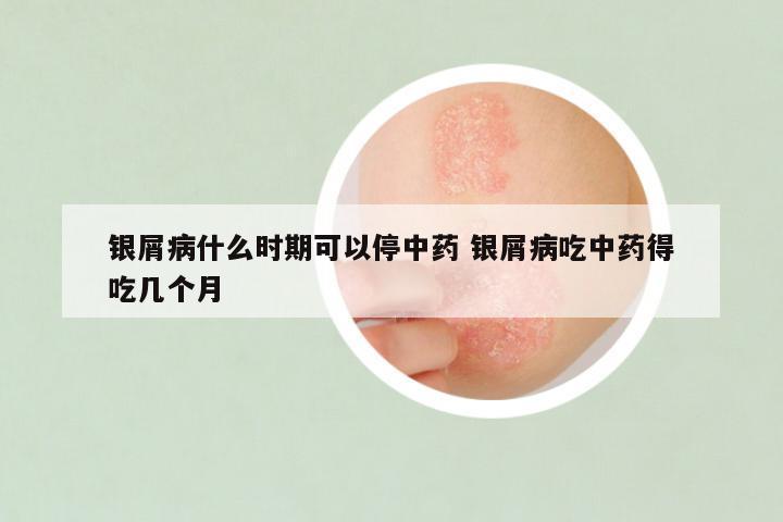 银屑病什么时期可以停中药 银屑病吃中药得吃几个月