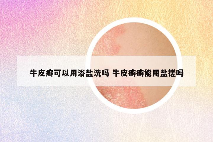 牛皮癣可以用浴盐洗吗 牛皮癣癣能用盐搓吗