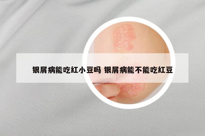 银屑病能吃红小豆吗 银屑病能不能吃红豆