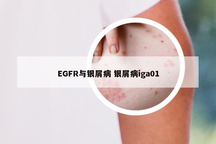 EGFR与银屑病 银屑病iga01