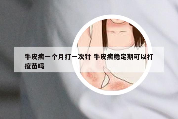 牛皮癣一个月打一次针 牛皮癣稳定期可以打疫苗吗