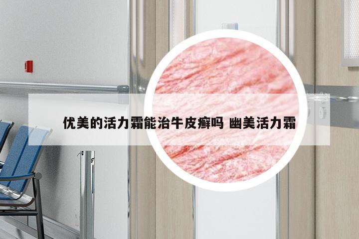 优美的活力霜能治牛皮癣吗 幽美活力霜
