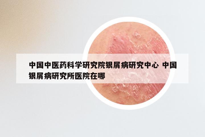 中国中医药科学研究院银屑病研究中心 中国银屑病研究所医院在哪