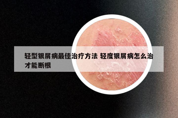 轻型银屑病最佳治疗方法 轻度银屑病怎么治才能断根