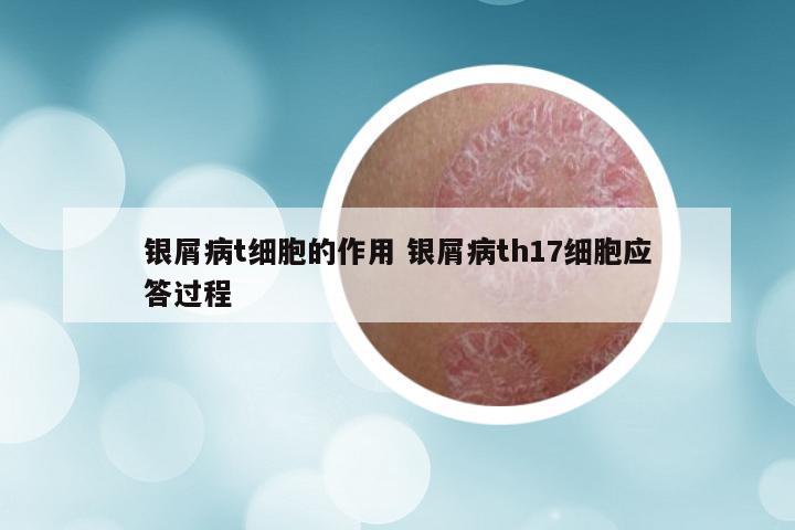 银屑病t细胞的作用 银屑病th17细胞应答过程