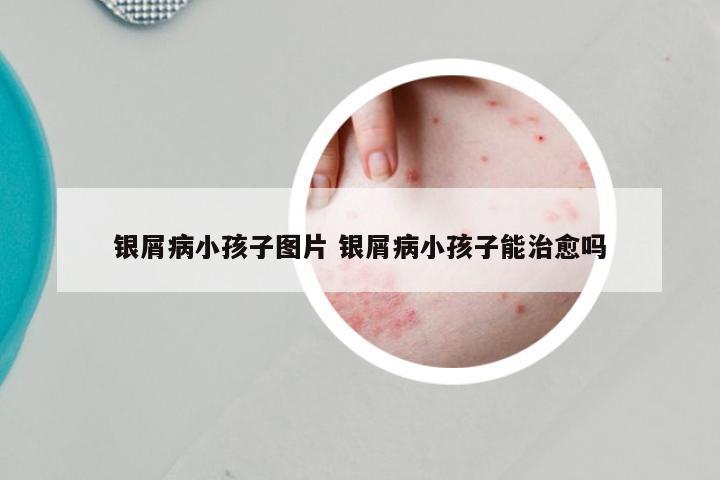 银屑病小孩子图片 银屑病小孩子能治愈吗