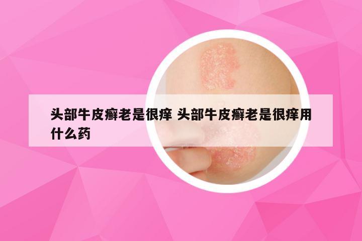 头部牛皮癣老是很痒 头部牛皮癣老是很痒用什么药