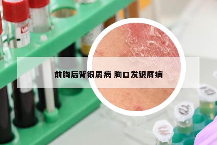 前胸后背银屑病 胸口发银屑病