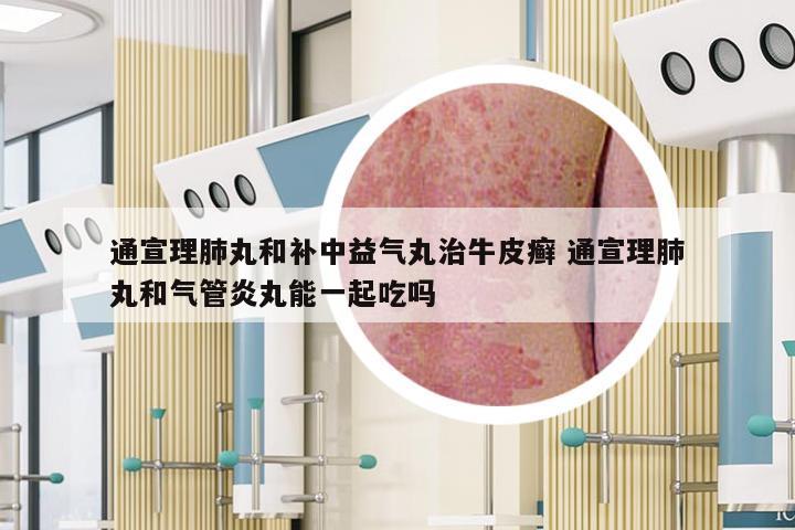 通宣理肺丸和补中益气丸治牛皮癣 通宣理肺丸和气管炎丸能一起吃吗