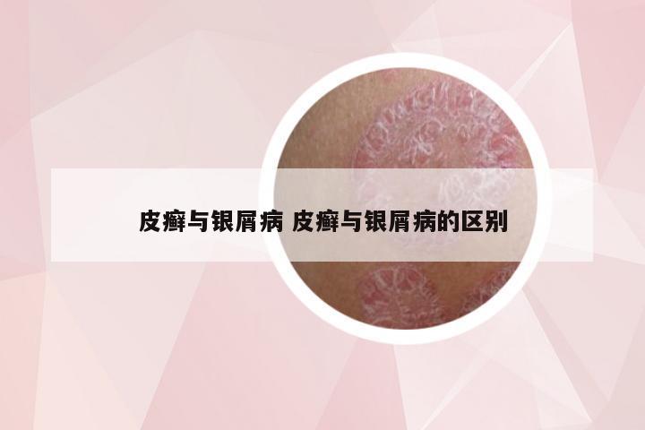 皮癣与银屑病 皮癣与银屑病的区别