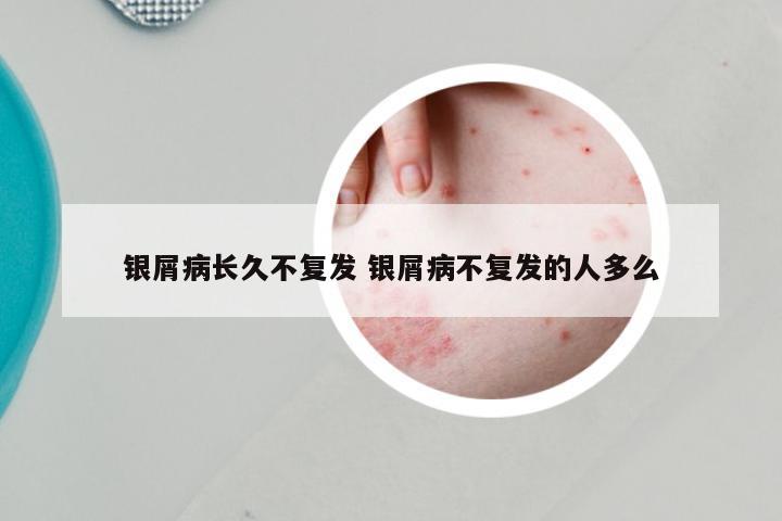 银屑病长久不复发 银屑病不复发的人多么