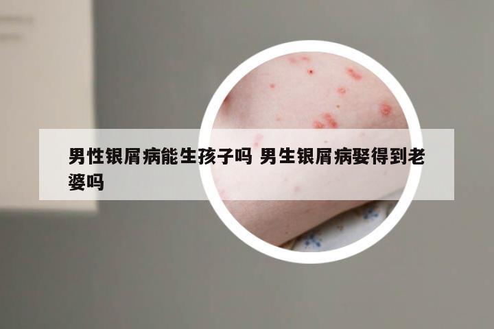 男性银屑病能生孩子吗 男生银屑病娶得到老婆吗